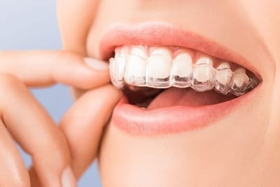 Top Rated Straightening Teeth Invisalign Doctors Gurgaon