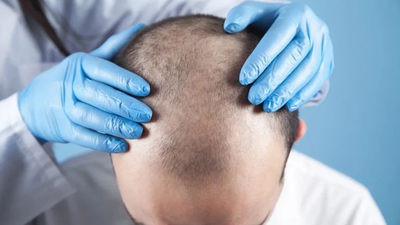 Top Rated Hair transplant Doctors Gurgaon