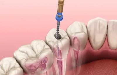 Root Canal Treatment Gurgaon