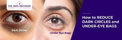 How Reduce Dark Circles Under-Eye Bags