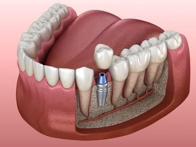 DENTAL IMPLANTS: Types, Treatment Procedure, Benefits, Risks & Cost