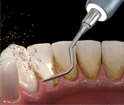 Dental Plaque