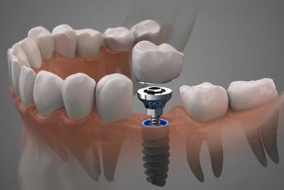 Best Dental Implant Clinic Near Me