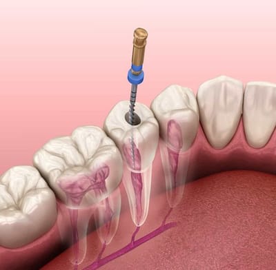 Root Canal Treatment Process