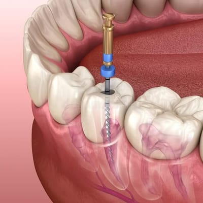 Root Canal Treatment in Gurgaon
