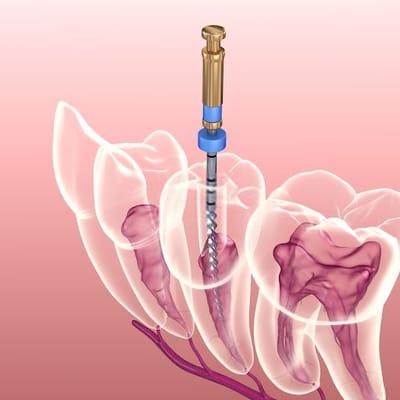 Root Canal Treatment