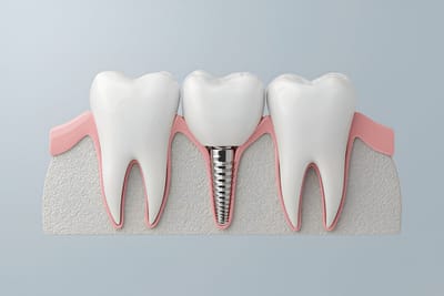 Types Benefits Dental Implants