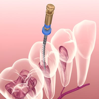 Save Your Tooth Professional Root Canal Care