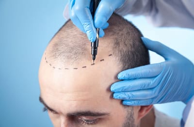 Best Hair Transplant Gurgaon