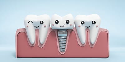 Dental Implants