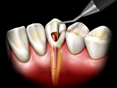 Pain-Free Root Canal Treatment Gurgaon