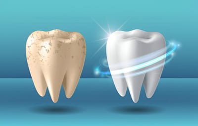 Cost Teeth Whitening Gurgaon