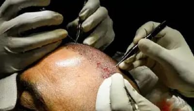 Hair Transplant Bhubaneswar
