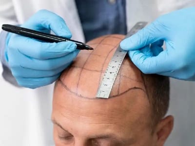 Hair Transplant Gurgaon