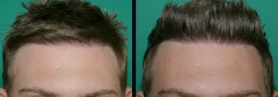 Maximum Density Hair Transplant Gurgaon