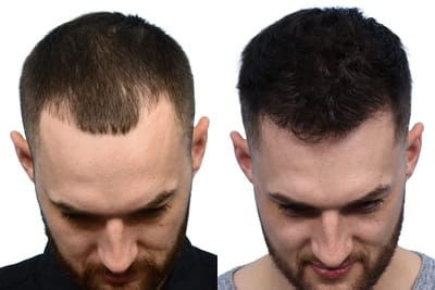 Natural Looking Hair Transplant Gurgaon
