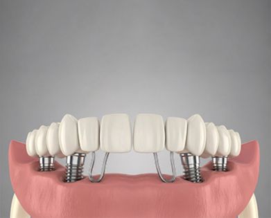 Dental Implants Gurgaon