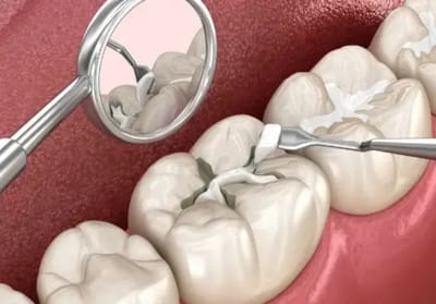 Dental Implants Invisalign Treatments Gurgaon