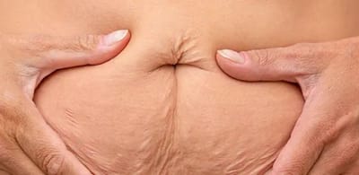 Skin Tightening Treatment South Delhi