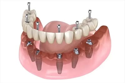 Dental Implants Gurugram