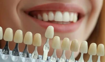 Veneers Treatment Gurgaon