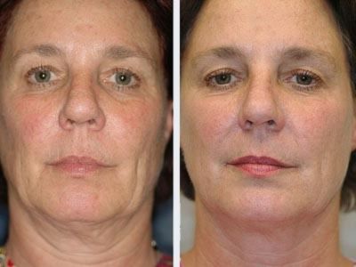 Anti aging Treatment South Delhi