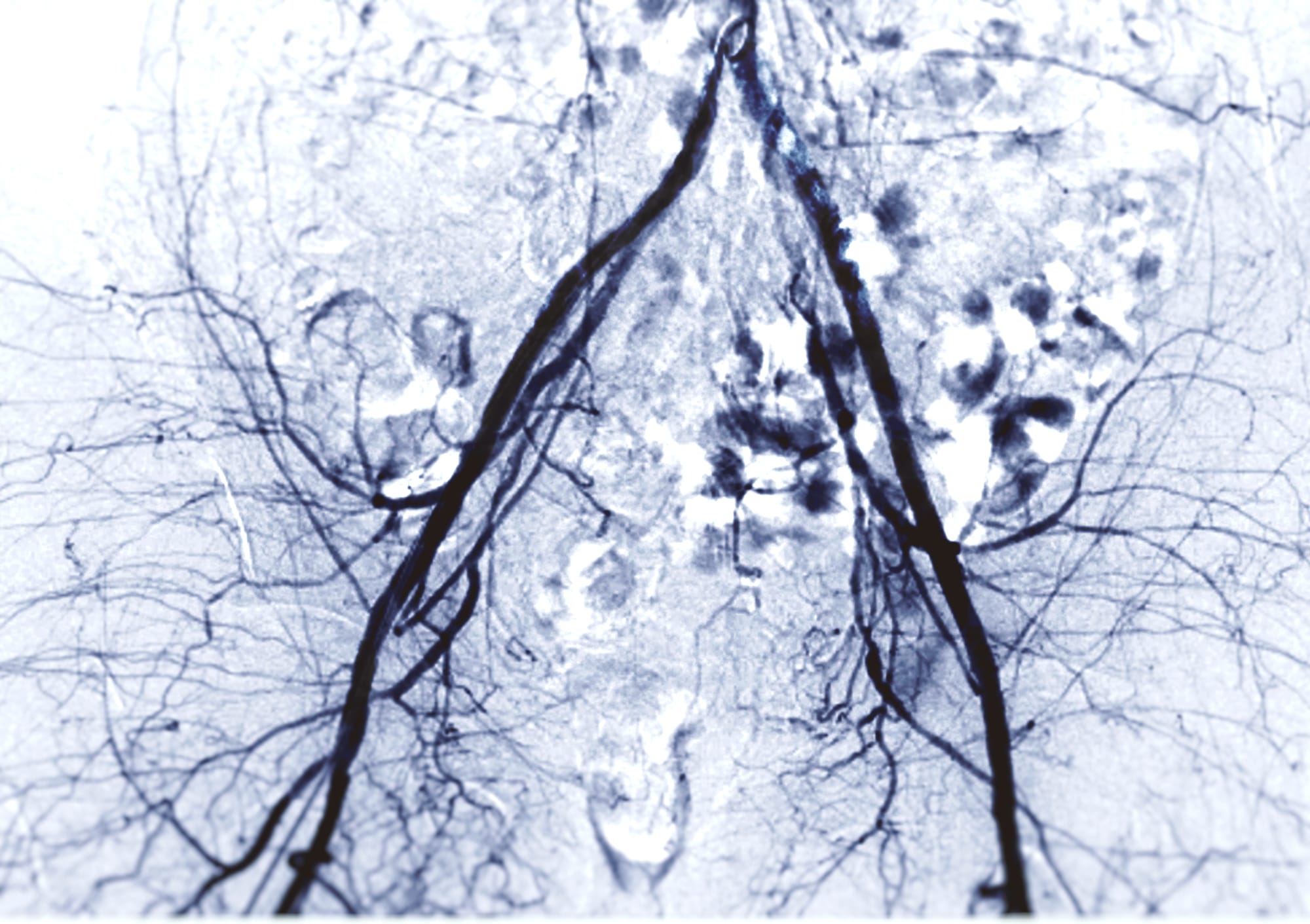 Peripheral Arterial Disease