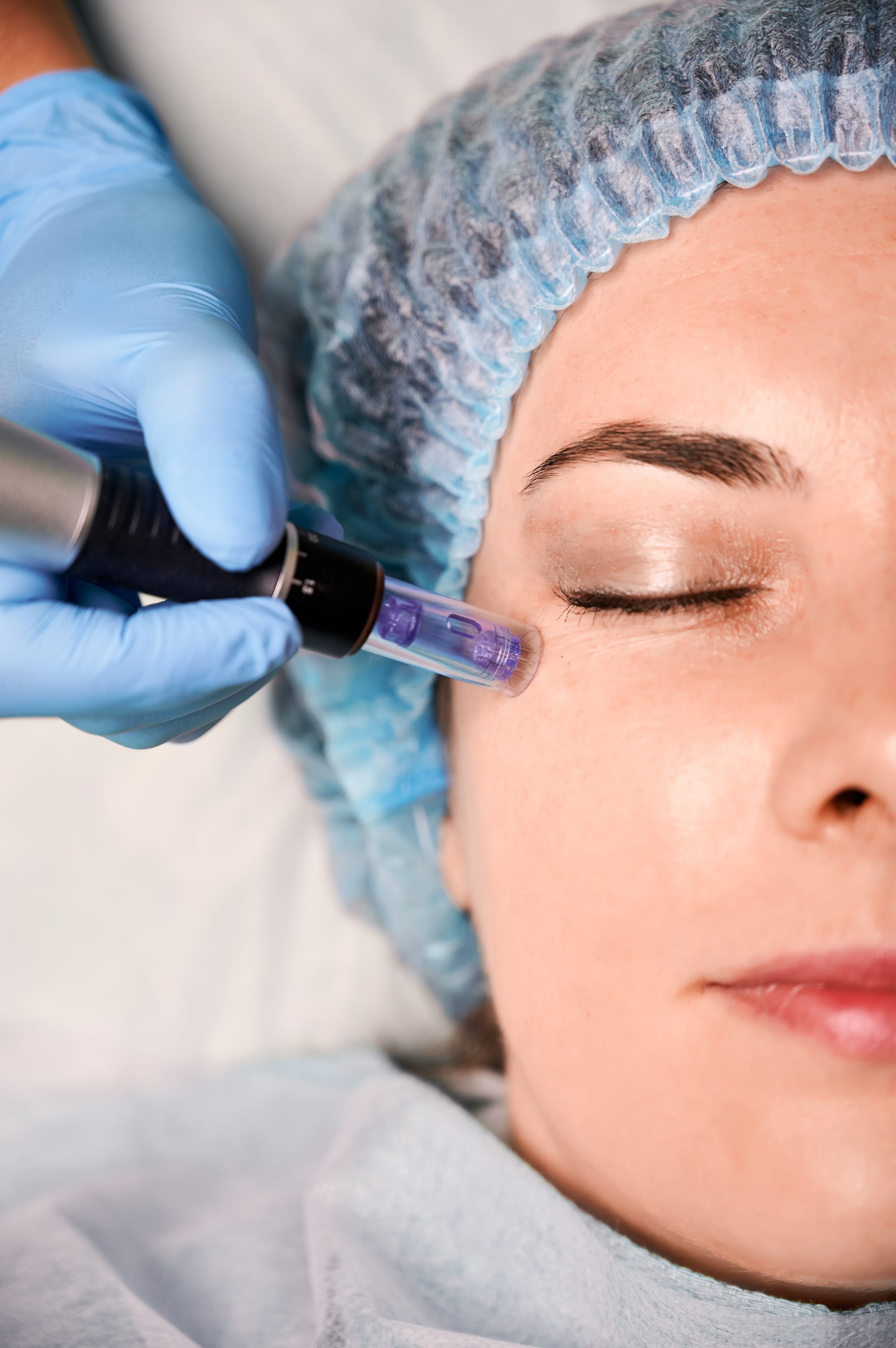 Microneedling in Rawalpindi – Treatment, Benefits, and Recovery