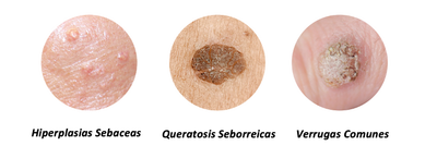 Porque salen verrugas en el cuerpo?