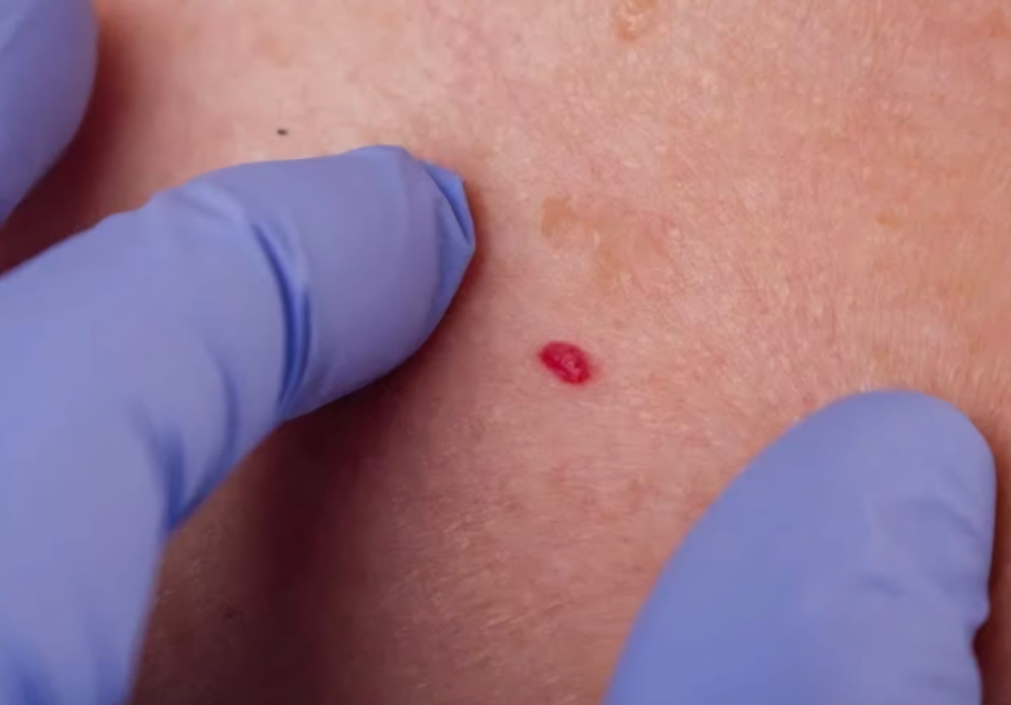 Cherry Angioma or Blood Spot? Everything You Need to Know