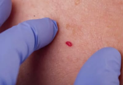 המנגיומה (Cherry Angioma) או נקודת דם? כל מה שחשוב לדעת