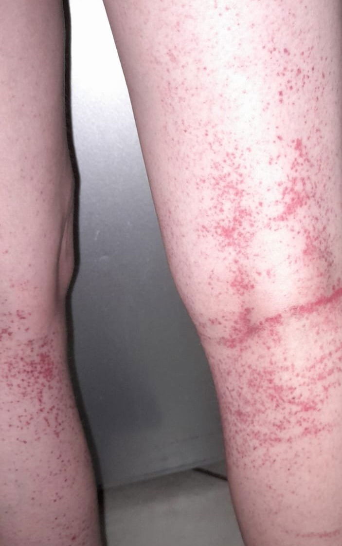 A rash that yields no diagnosis!