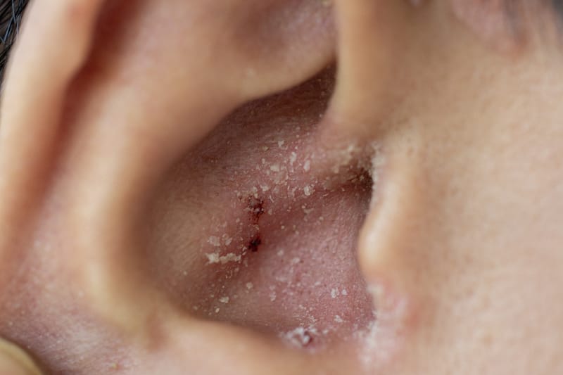 Eczema: A Guide to Relief.