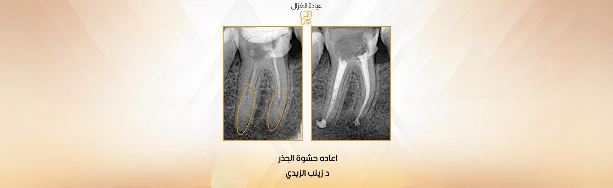 اعادة حشوة الجذر