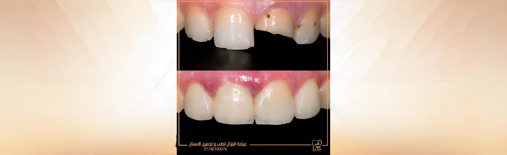 قسم الأسنان الأمامية