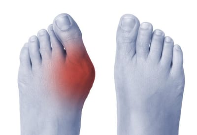 Can you straighten a bunion without surgery