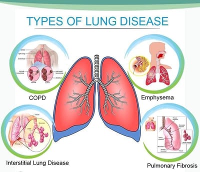 Raga-Chakra therapy and pulmonary issues