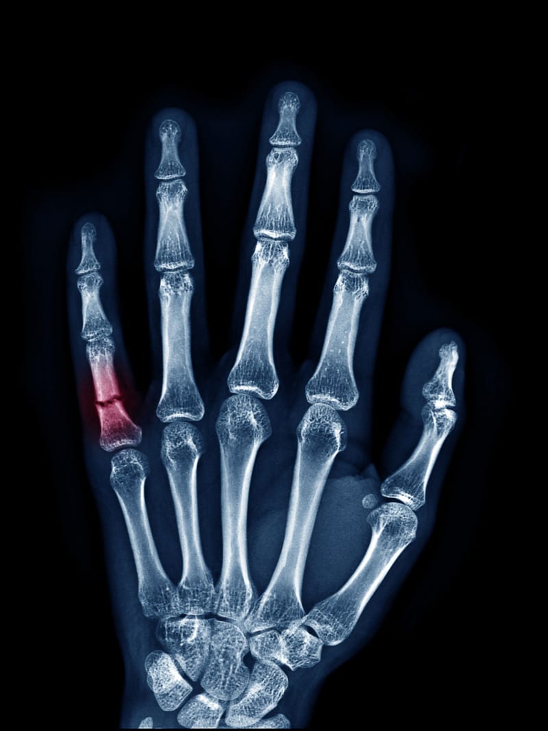 Hand and Wrist Fracture Course