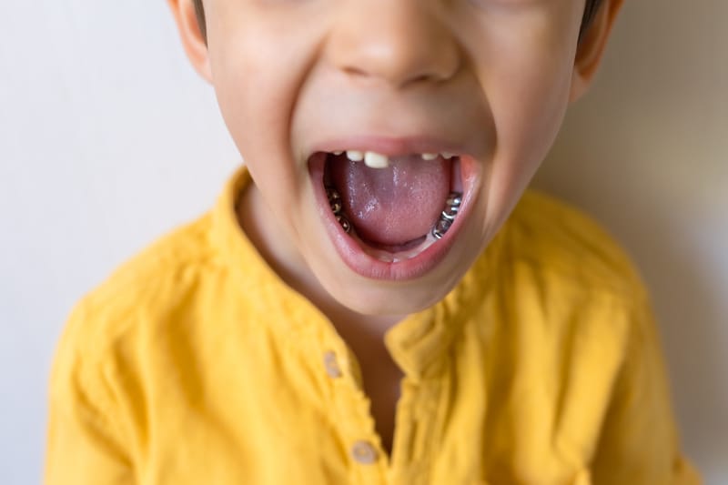 OŠETŘENÍ KAZU PODLE METODY HALLOVÉ