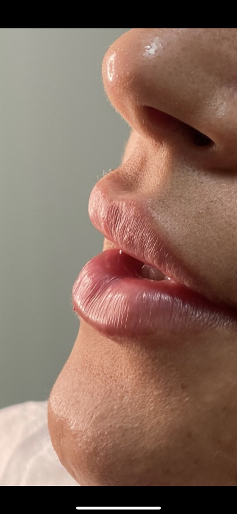 Preenchimento Labial.