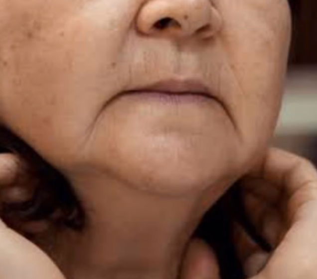 Preenchimento de Rugas de Marionetes.