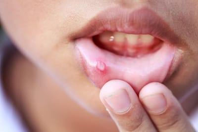 Natural Remedies for Common Oral Conditions: From Dry Mouth to Canker Sores