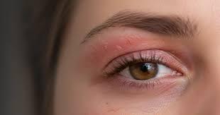 Effective Blepharitis Herbal Treatment for Clear, Comfortable Eyes