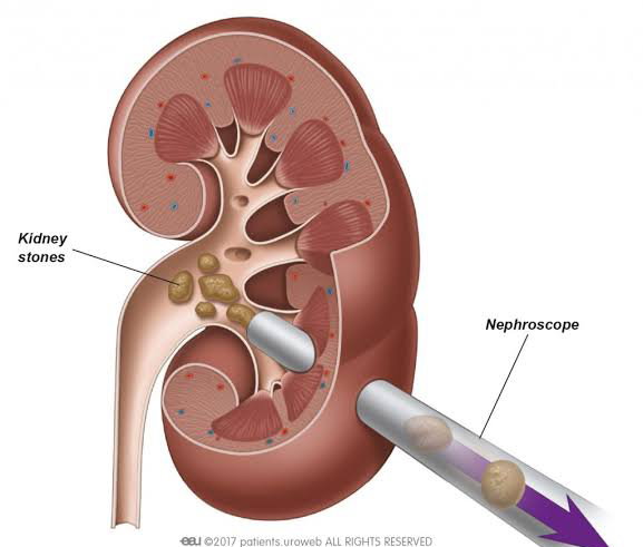 PCNL Kidney stone surgery