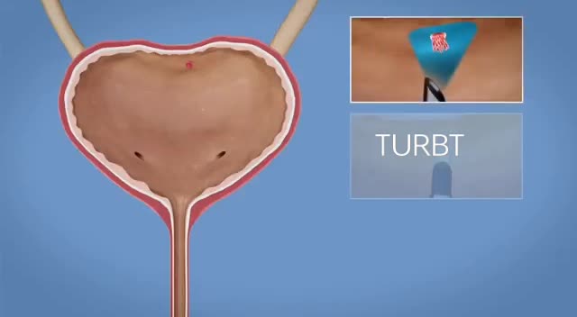 BLADDER TUMOR: TURBT