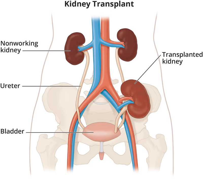 KIDNEY TRANSPLANT