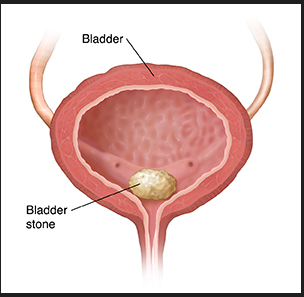 URINARY BLADDER STONES