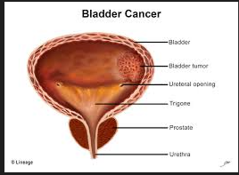 BLADDER CANCER