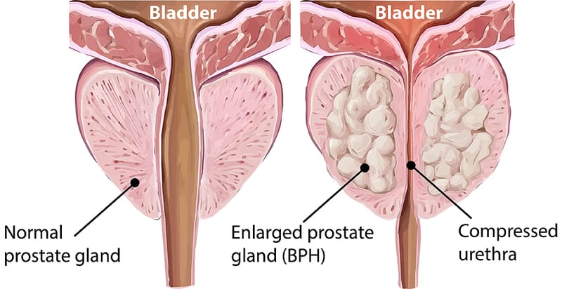 PROSTATE ENLARGEMENT