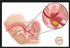 PROSTATE ABSCESS